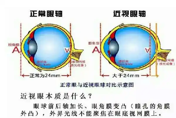 儿童眼轴最新科普知识，助力孩子视力健康保护